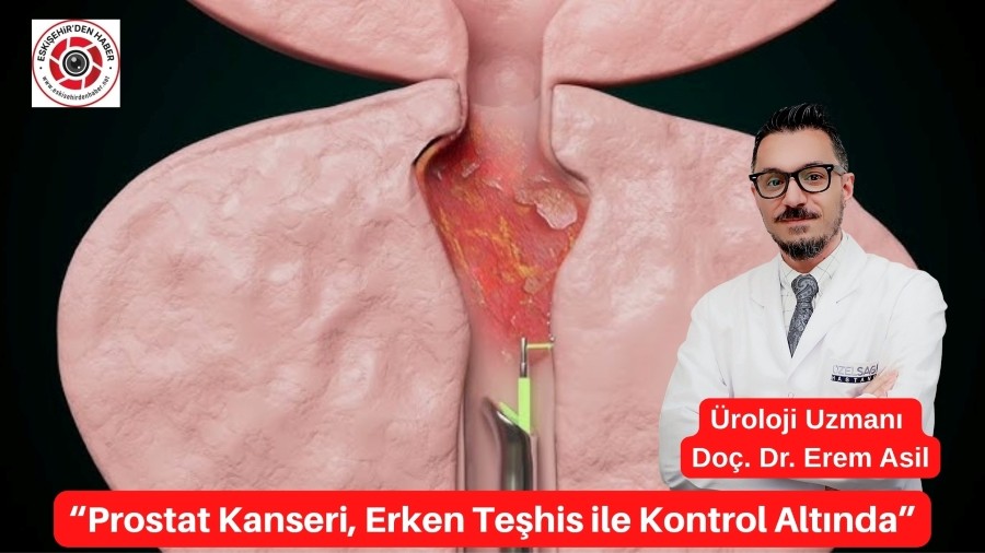 Prostat Kanseri, Erken Teşhis ile Kontrol Altında